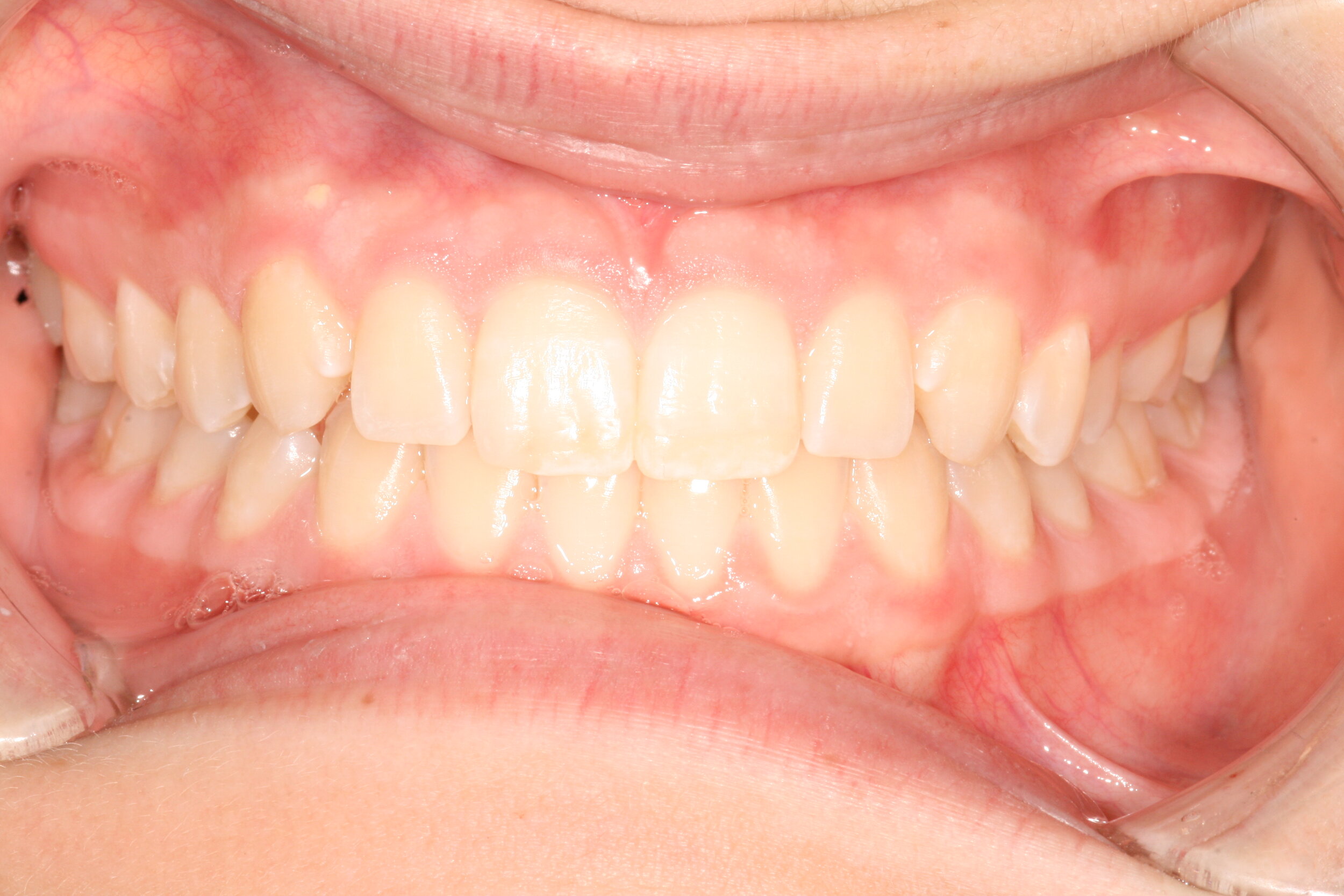  After repair of the top two front teeth. 