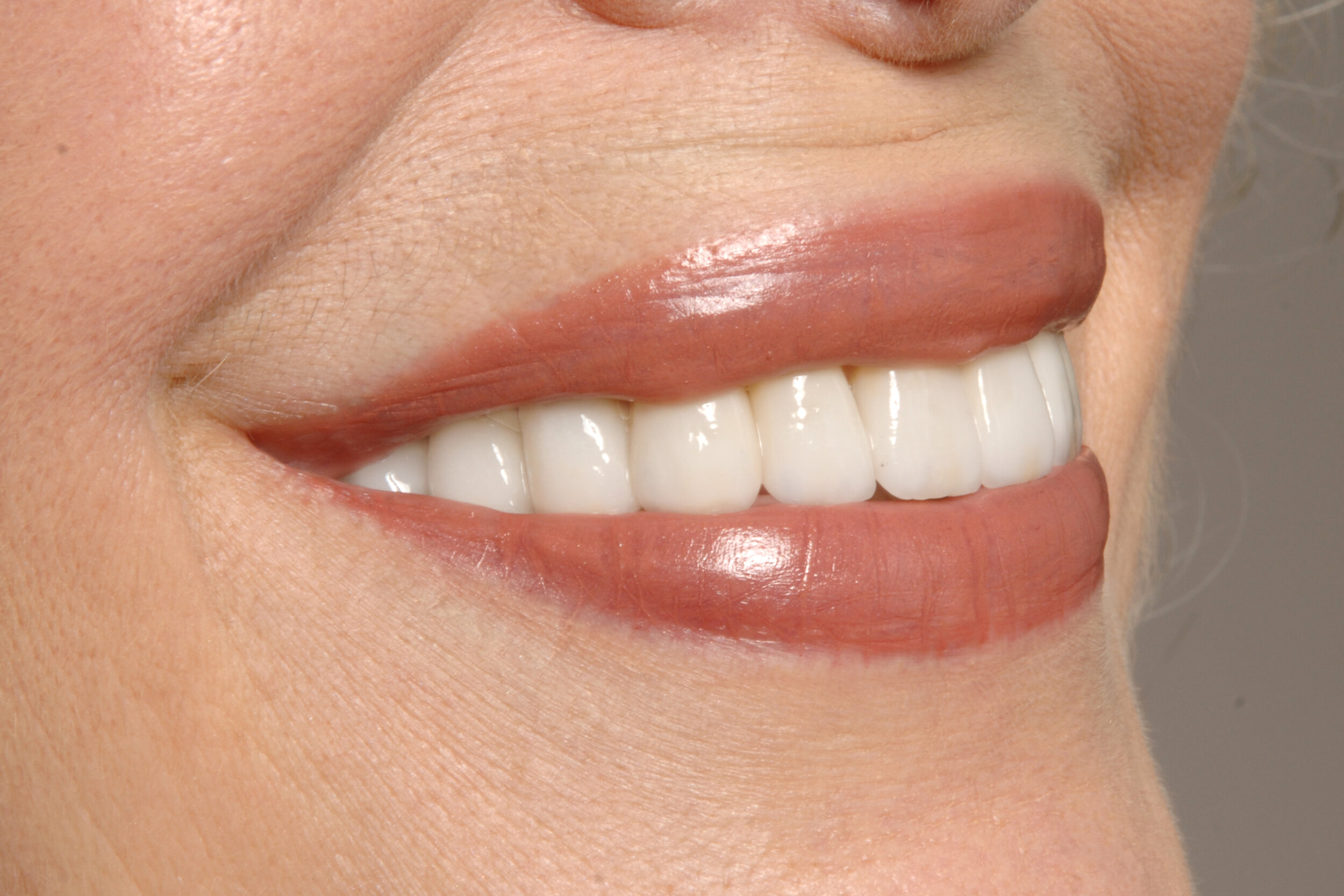  Case 1 - Right side natural smile after full mouth reconstruction 