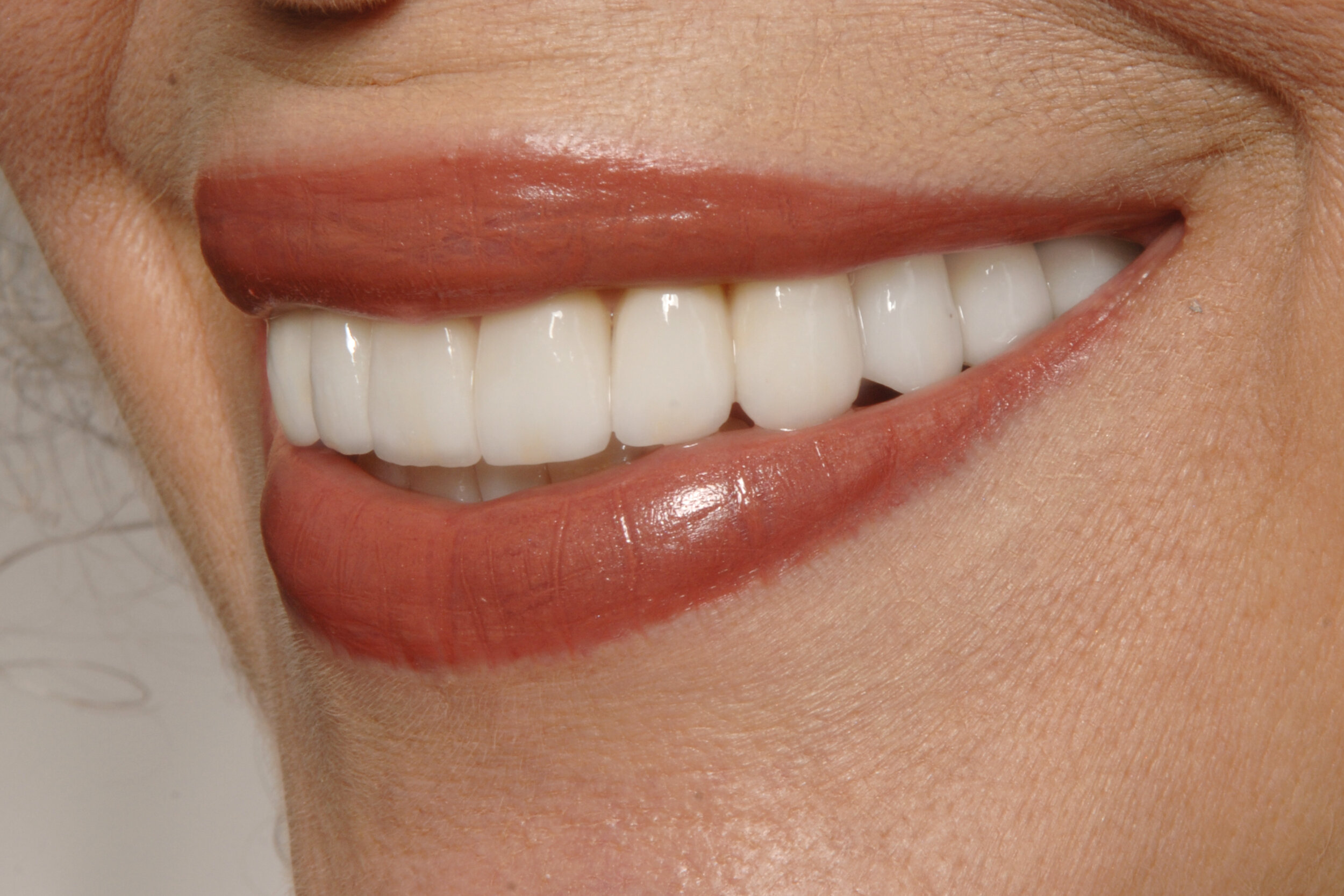  Case 1 - Left side natural smile after full mouth reconstruction 