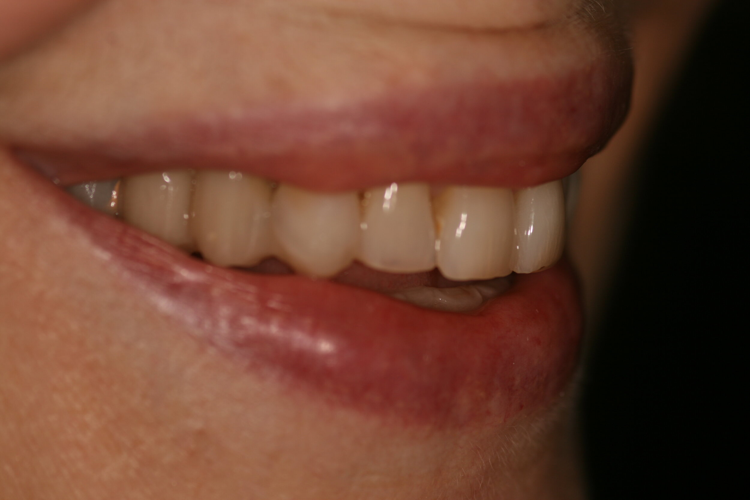  Case 1 - Right side natural smile before full mouth reconstruction 