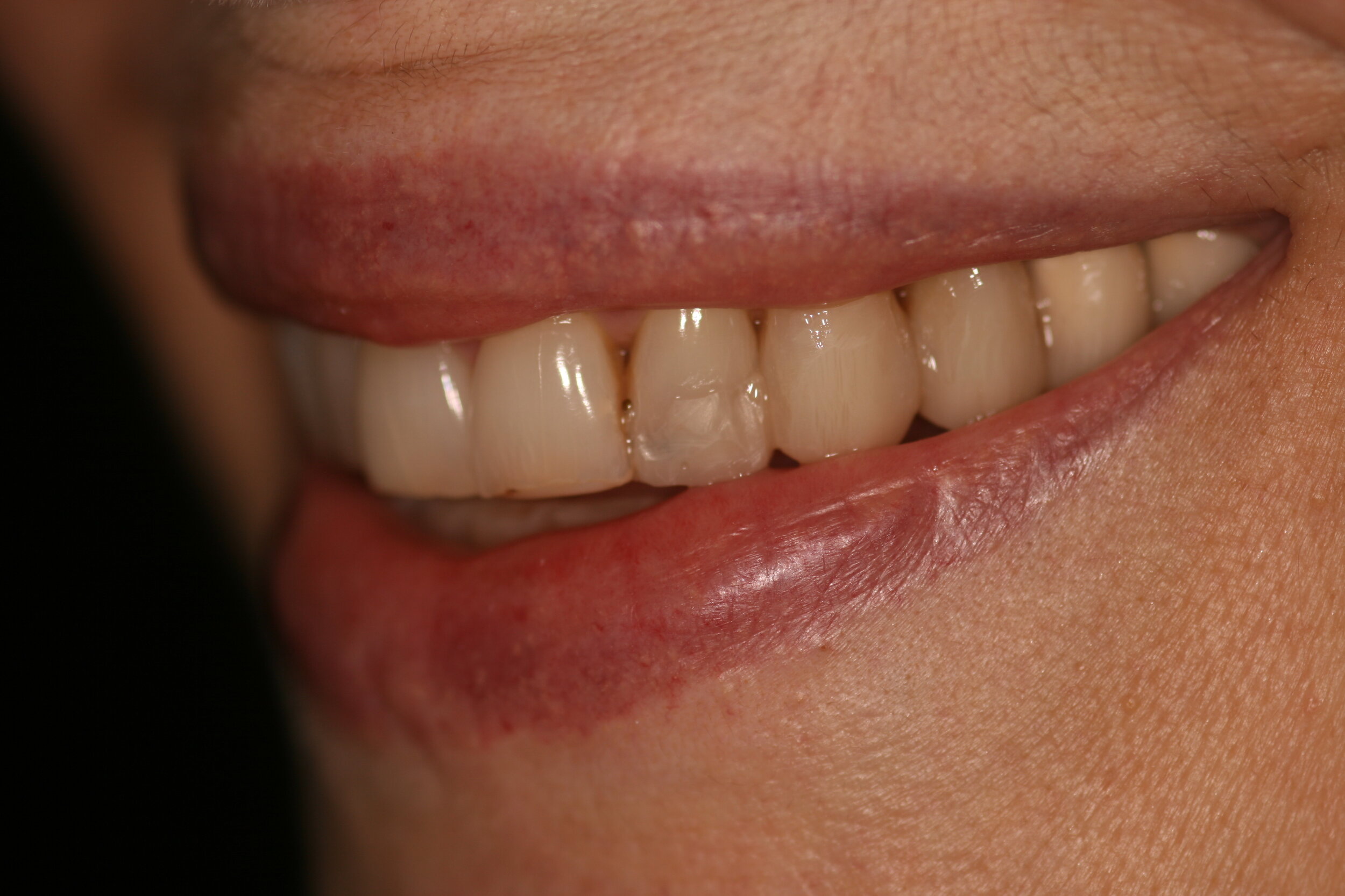  Case 1 - Left side natural smile before full mouth reconstruction 