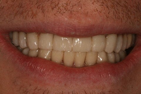  Case 2 - Full natural smile after full mouth reconstruction 