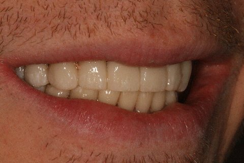  Case 2 - Right side natural smile after full mouth reconstruction 