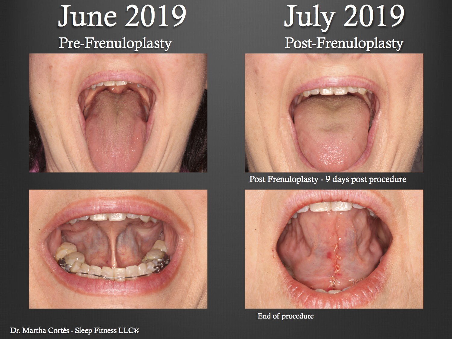  Case 1 Pre and Post tongue tie release diagnostic intra oral photos showing the changes in the tongues range of motion 