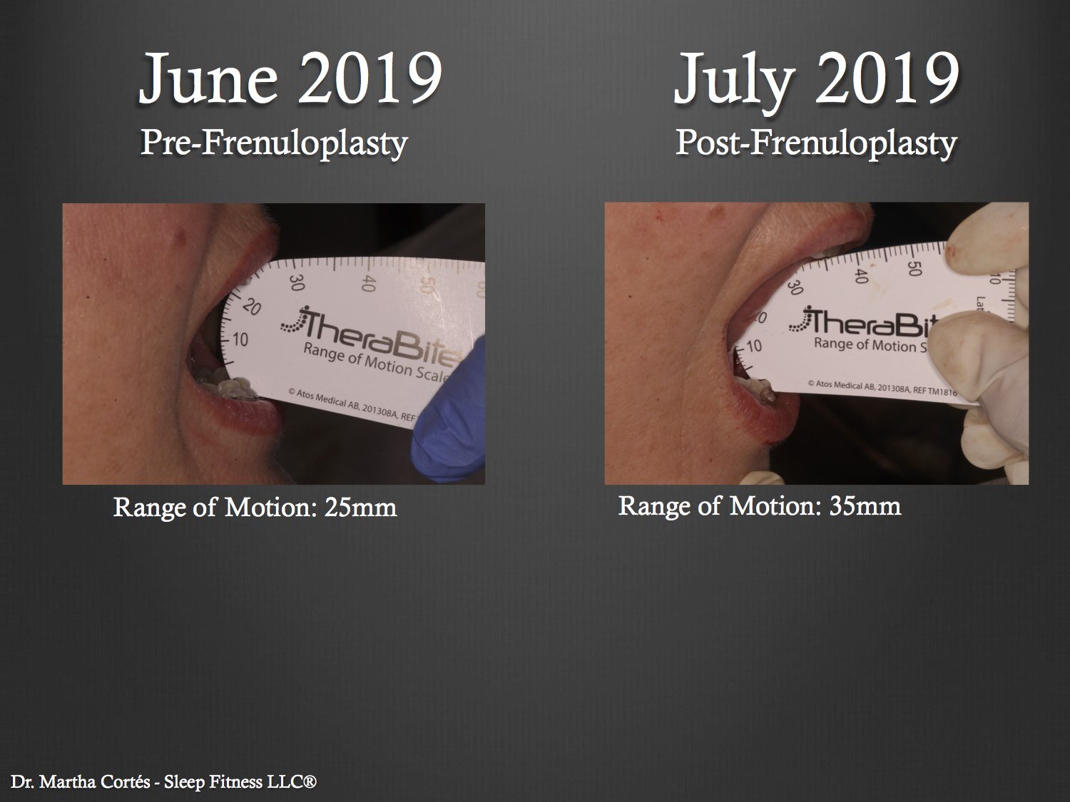  Case 1 Pre and Post tongue tie release diagnostic intra oral photos showing the increased range of motion 