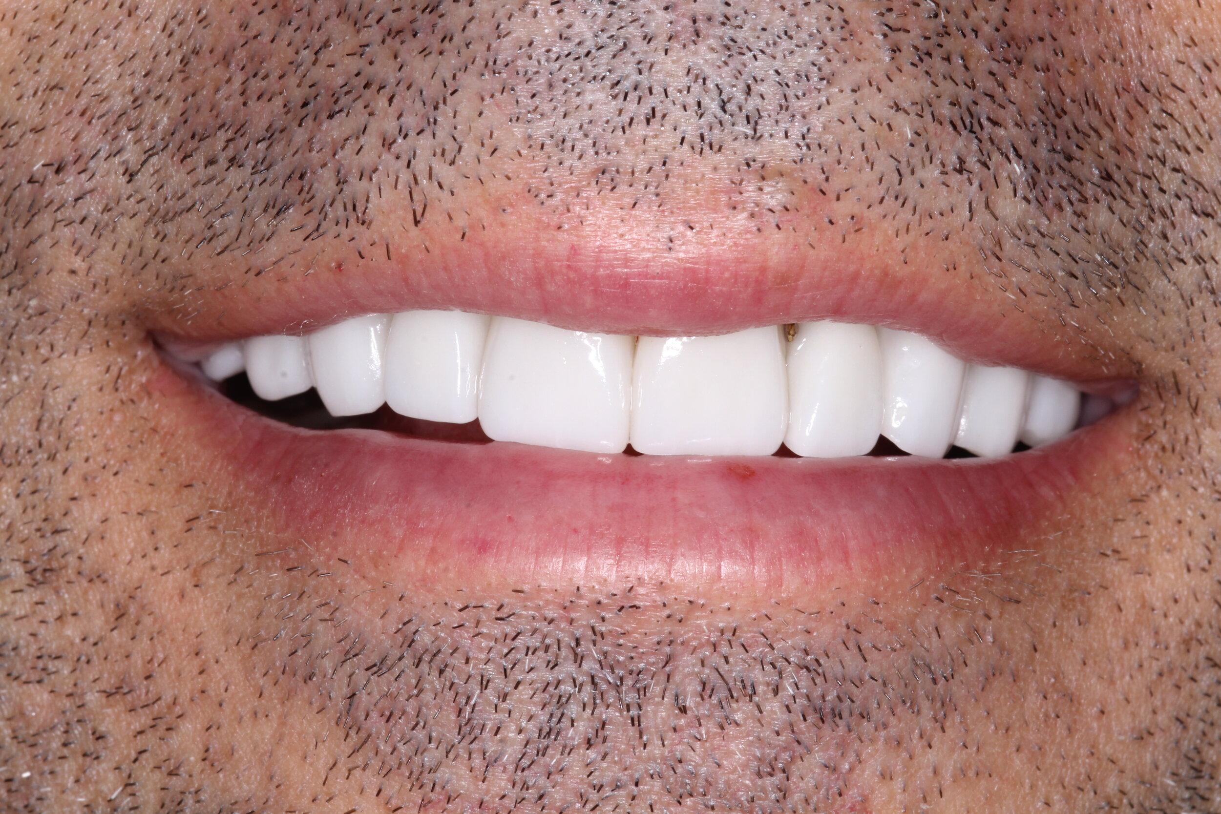  After Veneers - Natural Smile  Patient requested pearl white veneers  Veneers done by dental lab - Smiles of NY 