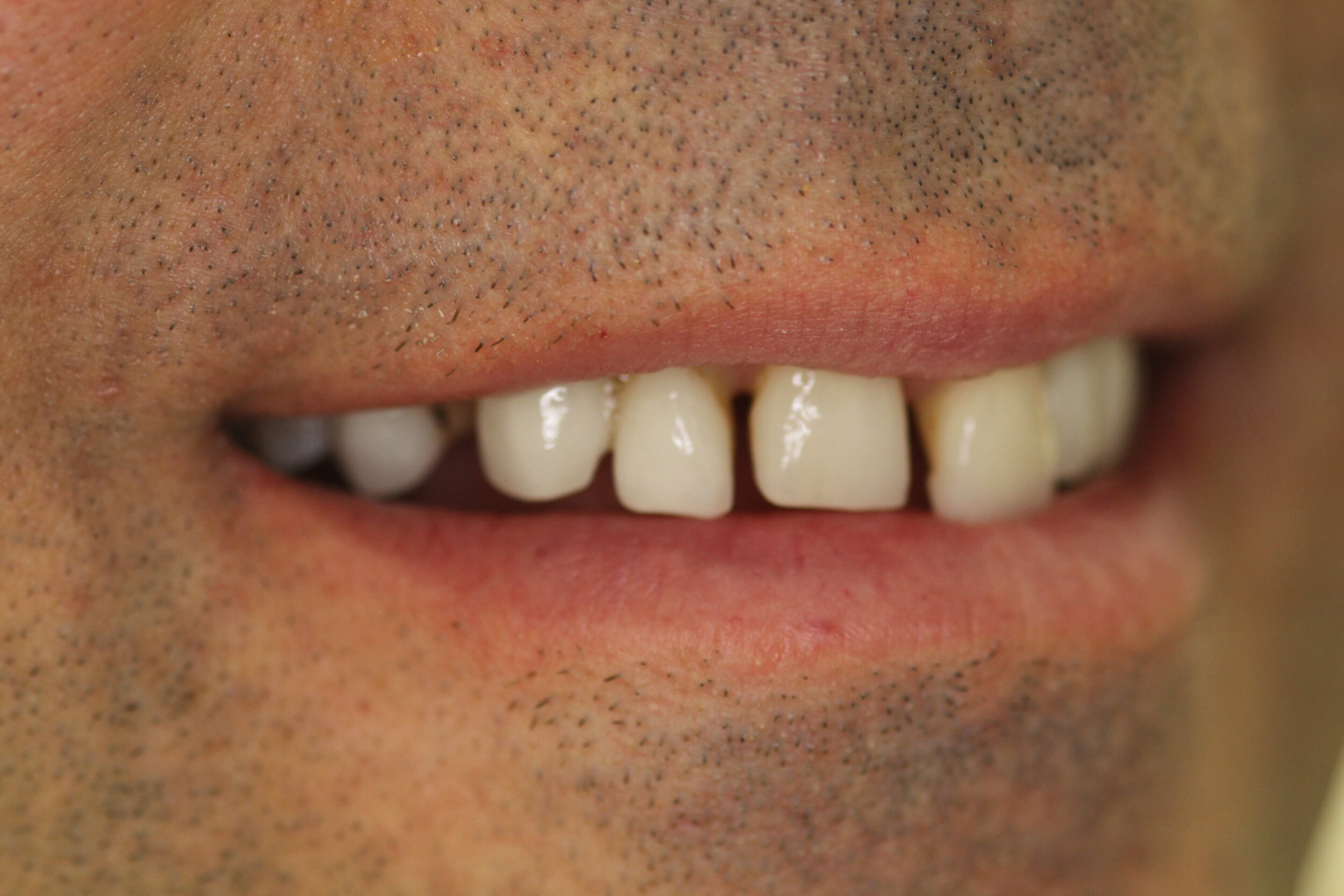  Before Veneers - Right Side Natural Smile 