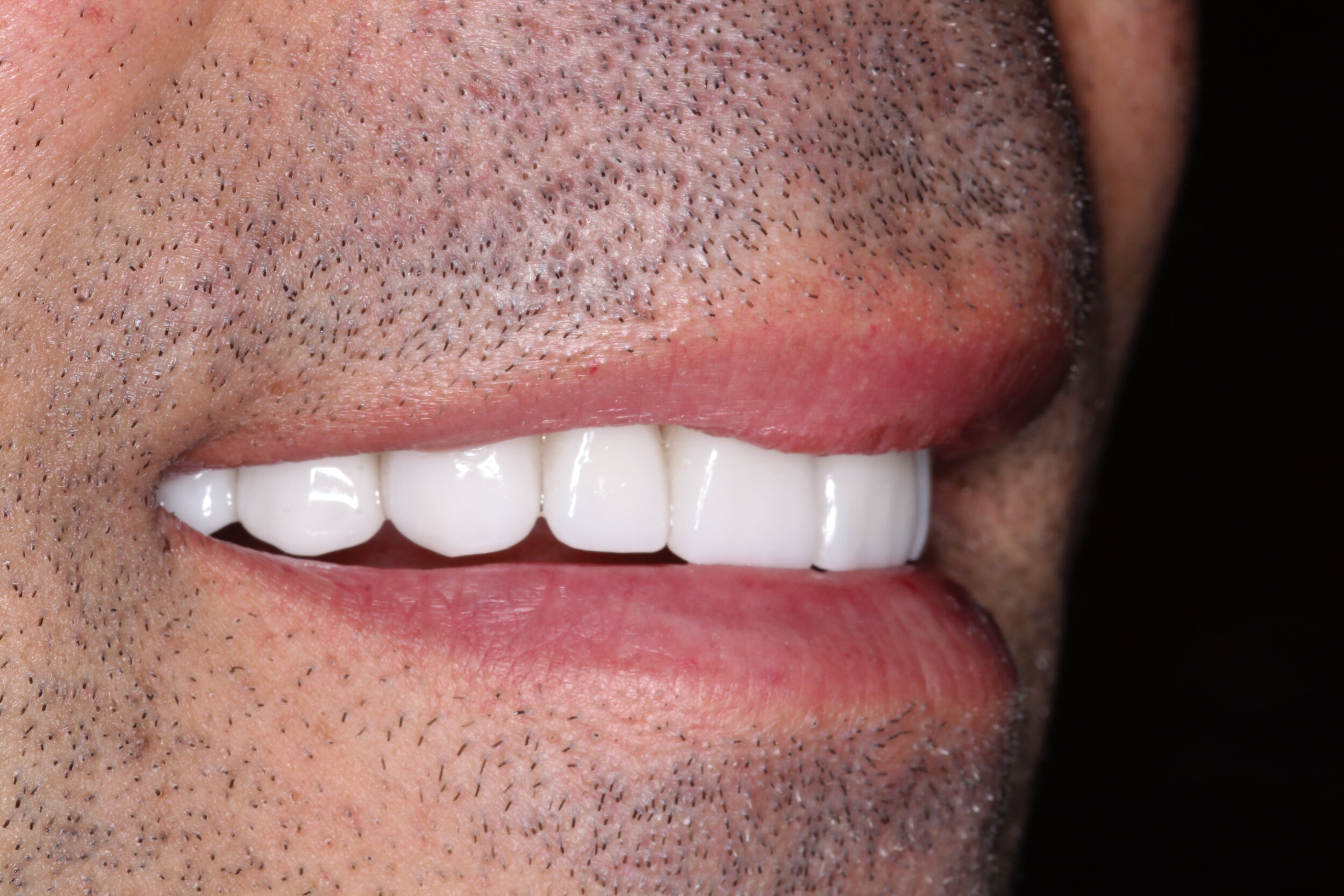  After Veneers - Right Side Natural Smile  Patient requested pearl white veneers  Veneers done by dental lab - Smiles of NY 