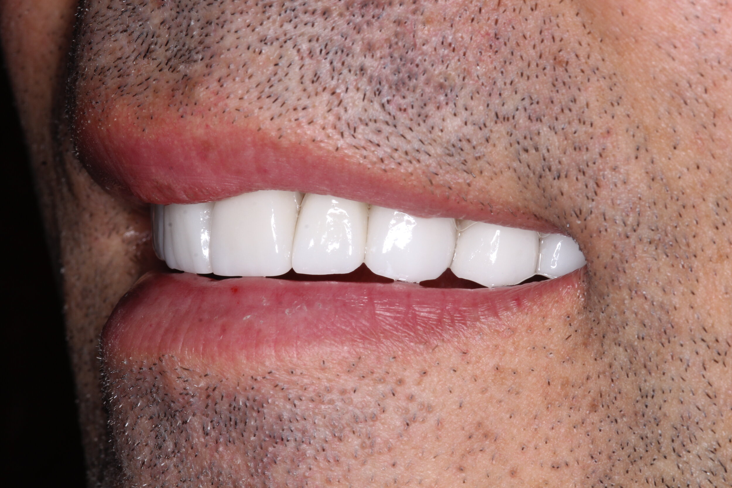  After Veneers - Left Side Natural Smile  Patient requested pearl white veneers  Veneers done by dental lab - Smiles of NY 