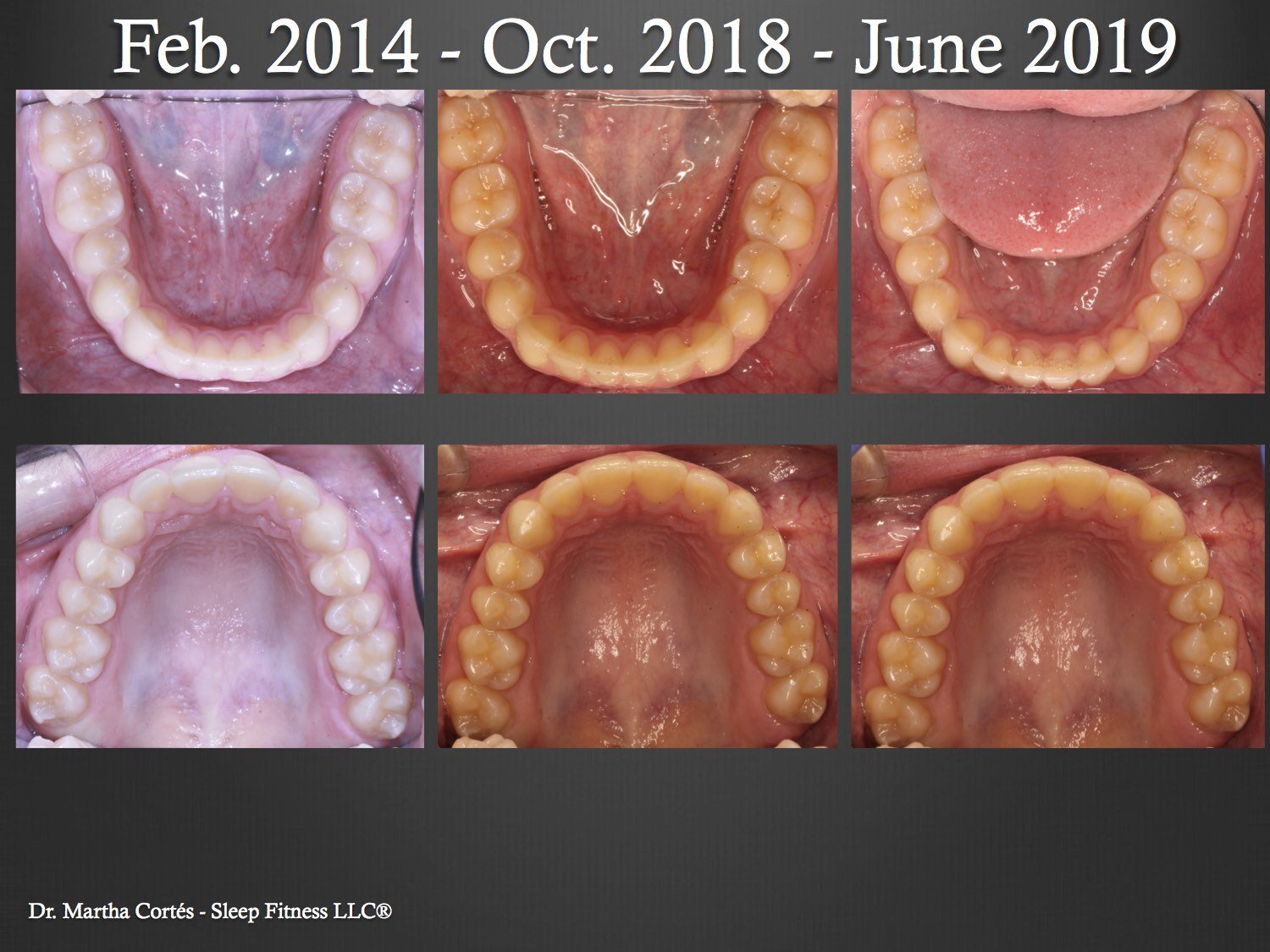  TMD Case 2_pg. 3  Treated with Upper DNA   Patient closed any spaces and open bite with Invisalign 