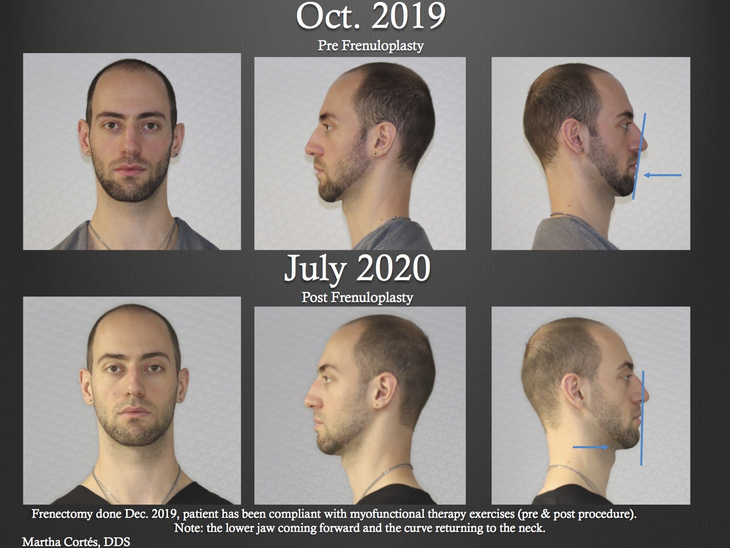  Case 2 Pre and Post tongue tie release diagnostic facial photos showing the changes that occurred in the face and lower jaw  