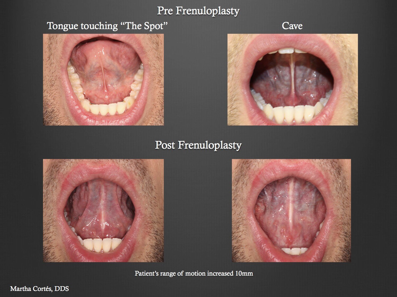  Case 2 Pre and Post tongue tie release diagnostic intra oral photos showing the changes in range of motion of the tongue 