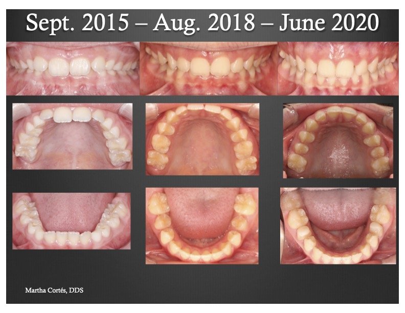  Class II Deep Bite - Case 2  Patient Treated with Upper &amp; Lower ALF 