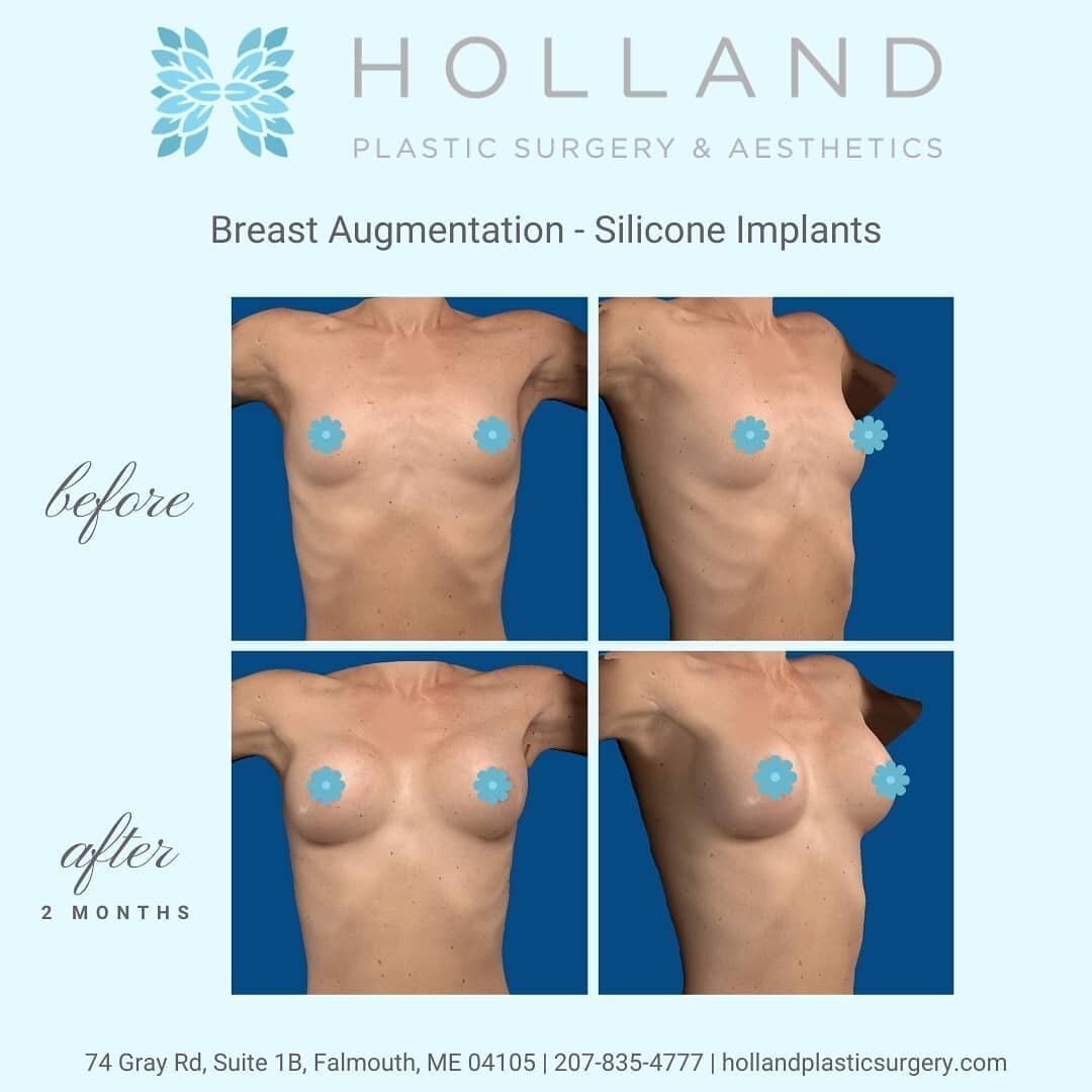 Breasts and bellies have always been Dr. Holland's most popular procedures. Her 20 years of board certified surgical experience really shines in results like these! 😍
&bull;
#tummytuck #breastaugmentation #plasticsurgery #plasticsurgeron #surgery #b