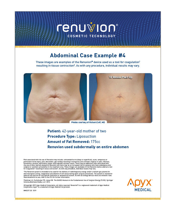 Renuvion® Tightening — Holland Plastic Surgery & Aesthetics