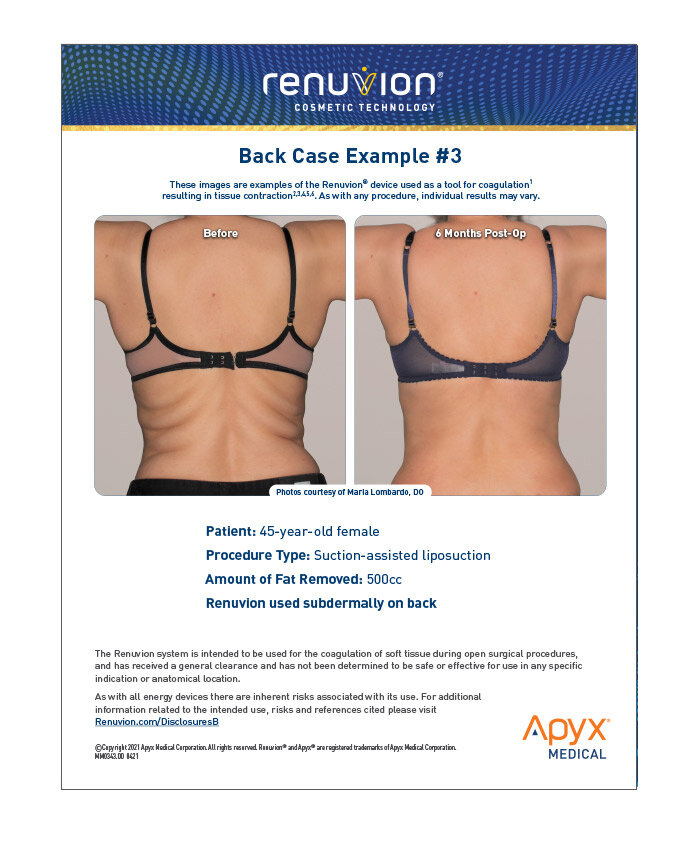 The Future of Skin Tightening is Here: Renuvion - BEAUTY by BUFORD