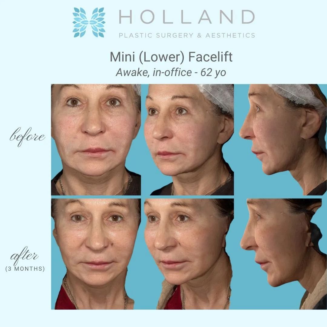 Our patient pictured underwent a full facelift with another surgeon over 10 years ago. This time, Dr. Holland focused on refreshing her lower face, utilizing 50% of her existing scars to minimize additional scarring. The procedure was completed in-of