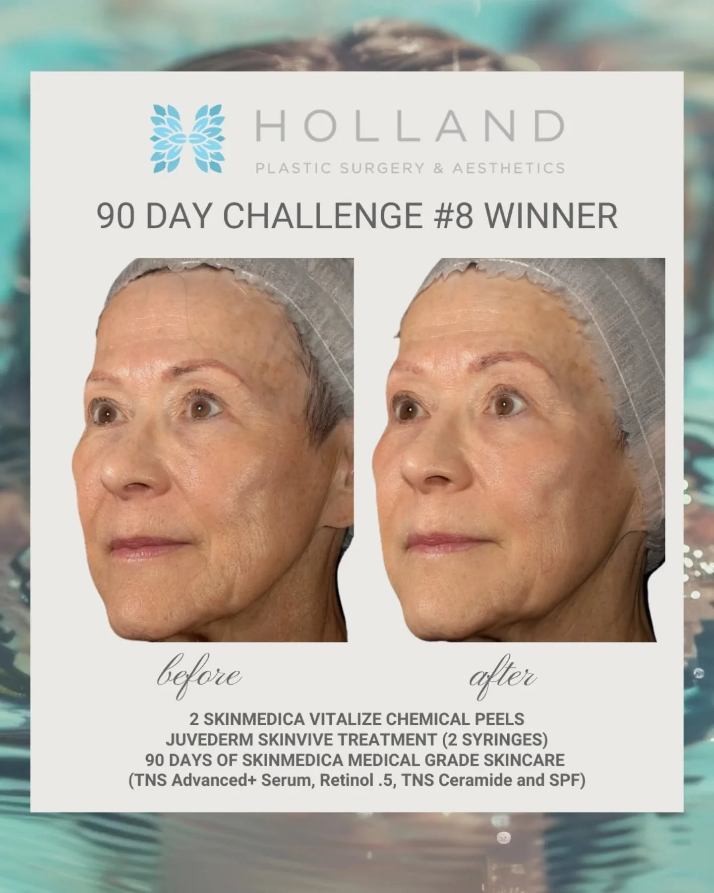 We may be a little late announcing our winner this year, but we&rsquo;re just as excited as ever&nbsp;✨

This patient achieved beautiful improvements in&nbsp;skin texture and tone&nbsp;from her peels, along with&nbsp;added brightness, hydration, and 