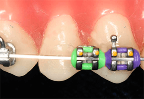 braces-broken-bracket.png