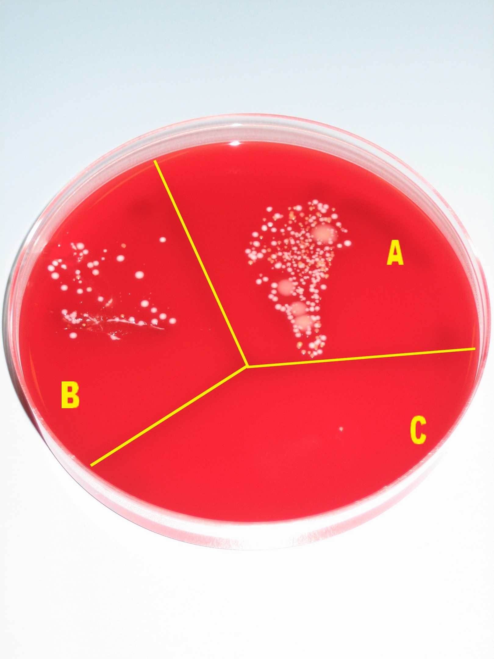 “ Microbial growth on a blood agar plate without any procedure (sector A), after washing hands (sector B), and after disinfecting hands with alcohol (sector C).” You can see that washing hands with just soap and water barely does anything to prevent disease being spread from doctor to patient, while full disinfection does a very good job.