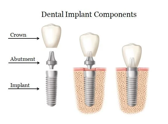 Parts of a dental implant showing the implant, abutment and dental crown