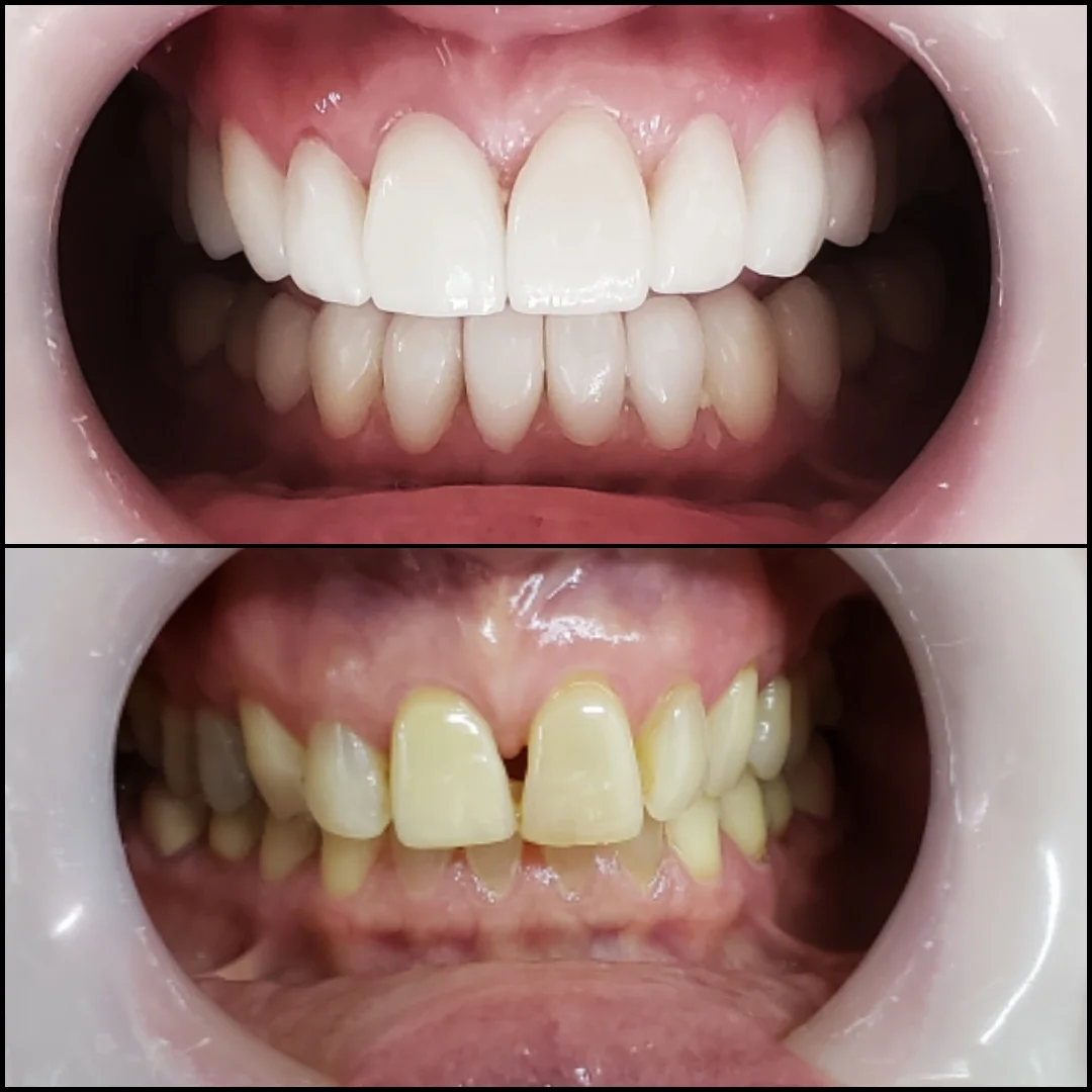 Beatrice Before After Testimonial Review Porcelain Veneers - Dental Tourism Colombia (Dr. Julio Oliver, Cartagena)