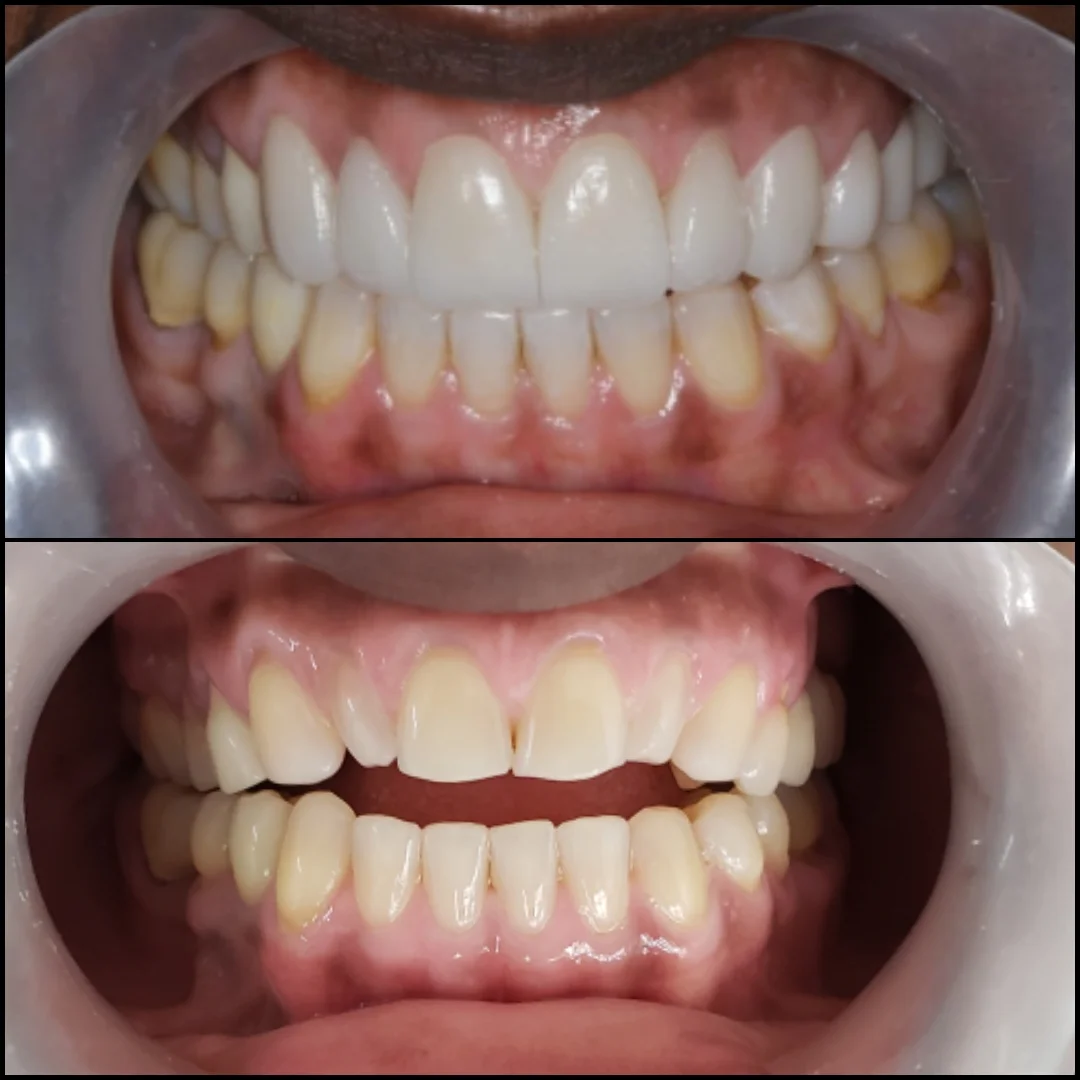 The cost of root canals in Colombia 2