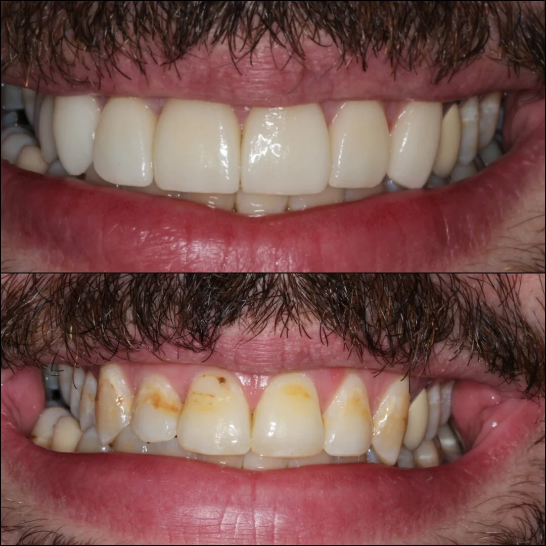 Porcelain veneers by Dr. Julio Oliver in Cartagena (Before and After) - Dental Tourism Colombia
