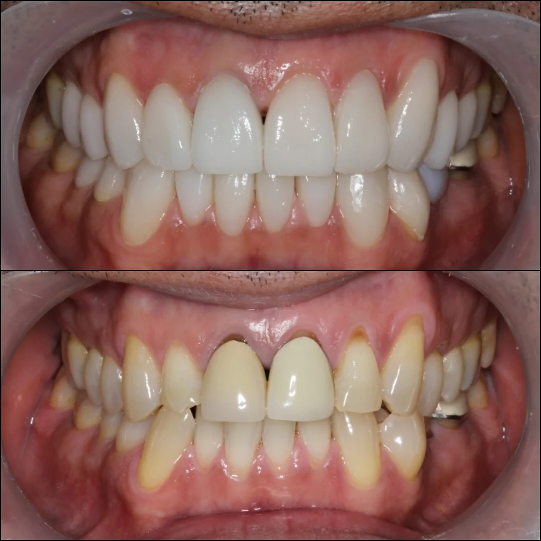 Porcelain crowns by Dr. Julio Oliver in Cartagena, Colombia