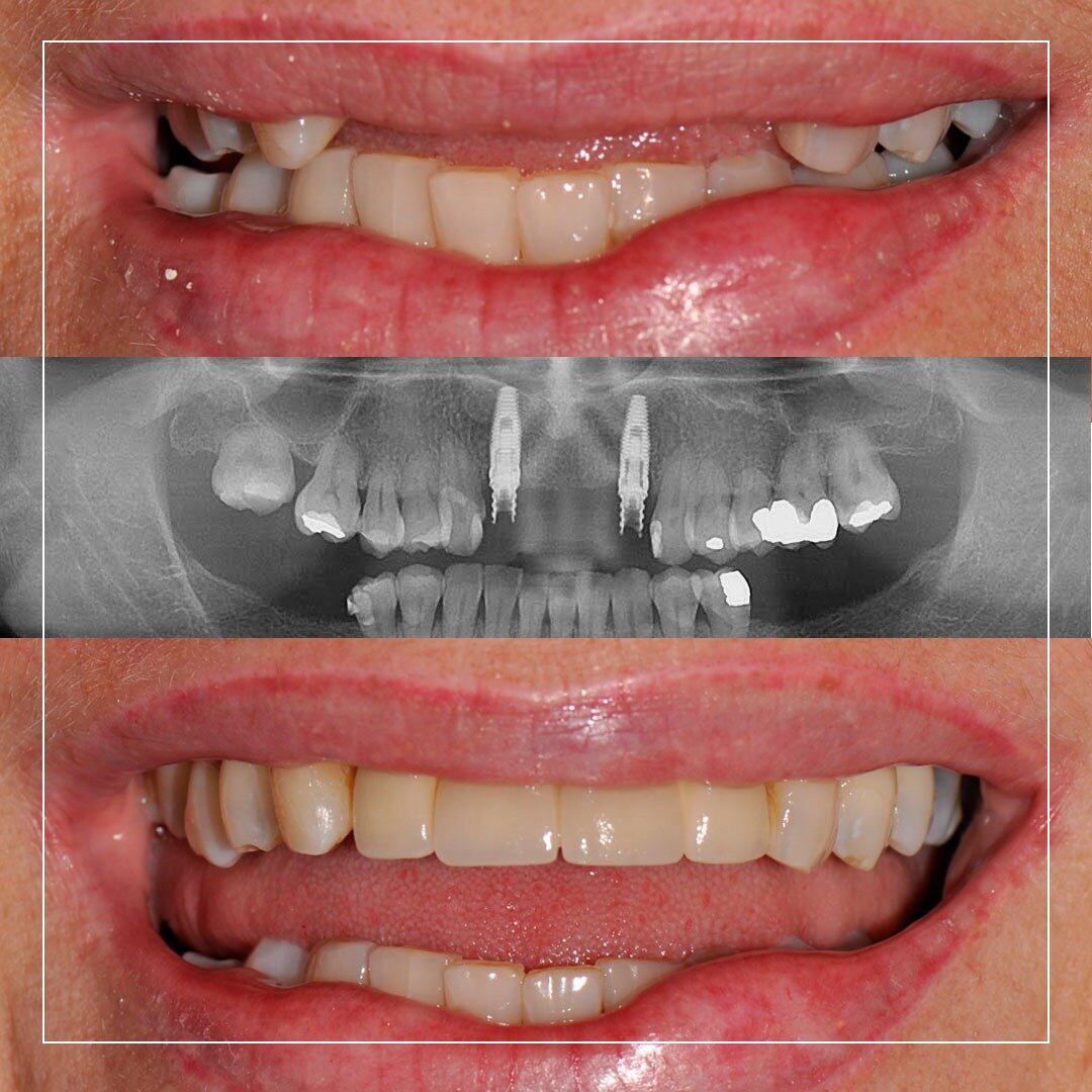 Dental Implants in Colombia (Cost of Titanium, All on Four, All on Six ...