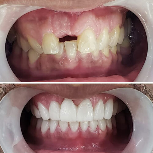 Dental Tourism Colombia