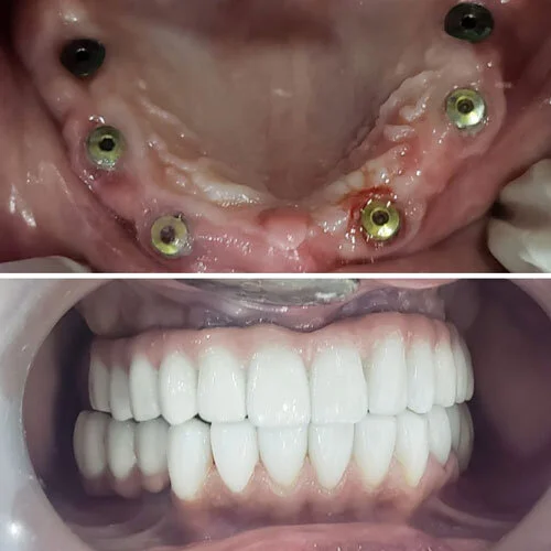 Dental Implants in Colombia — Dental Tourism Colombia