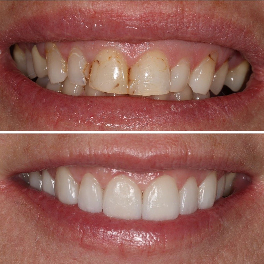 dental tourism veneers