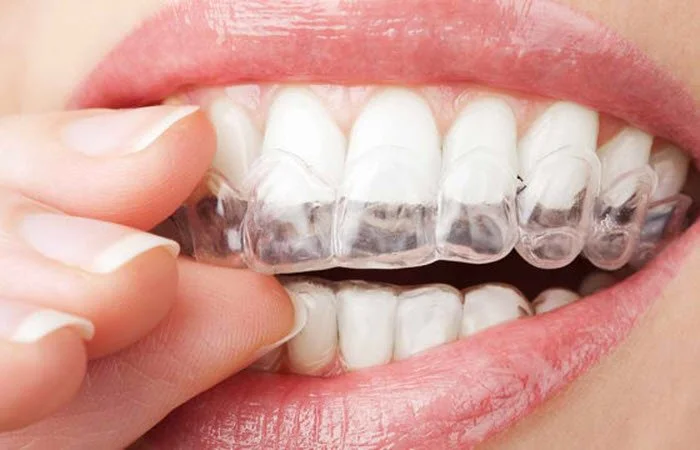 Take-Home Whitening Kit in Medellin