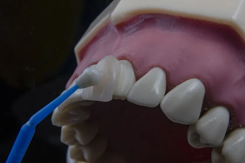 Best Country to Get Veneers? - Dental Tourism Colombia