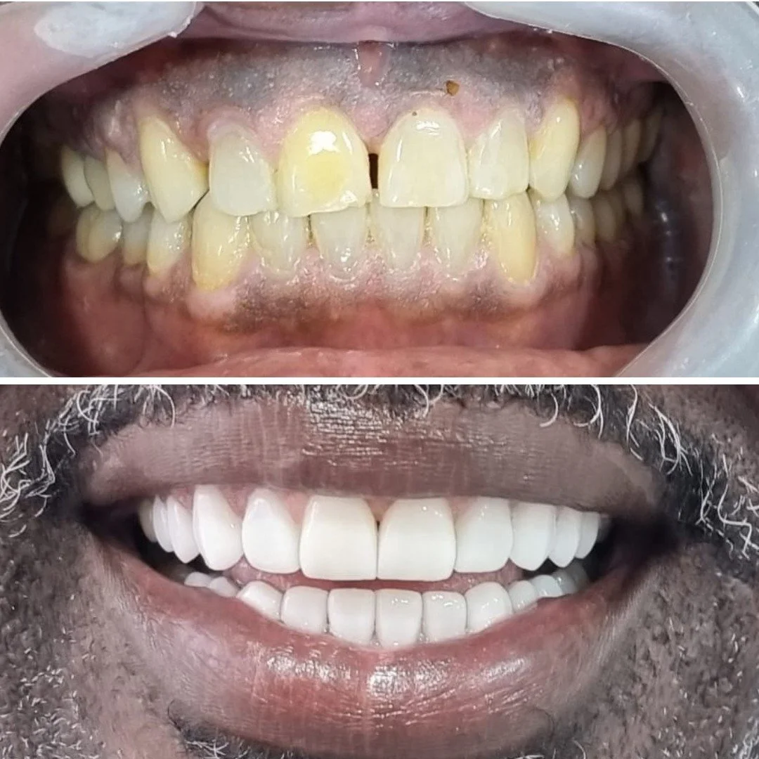 Before and After, Porcelain veneer smile makeover in Medellin, Colombia