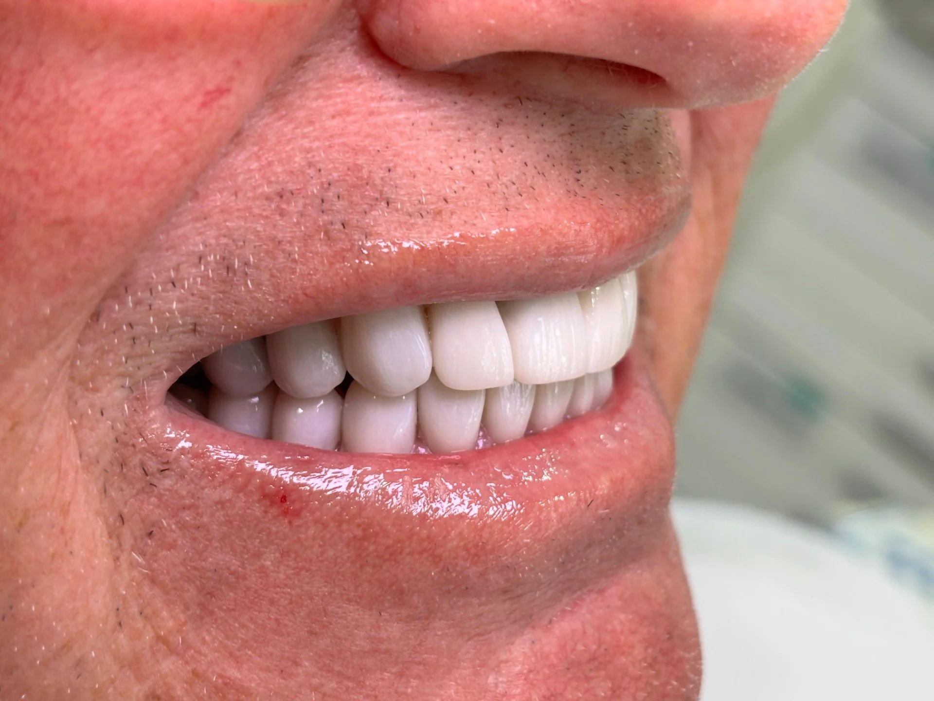 Dental implants done in Cartagena, Colombia