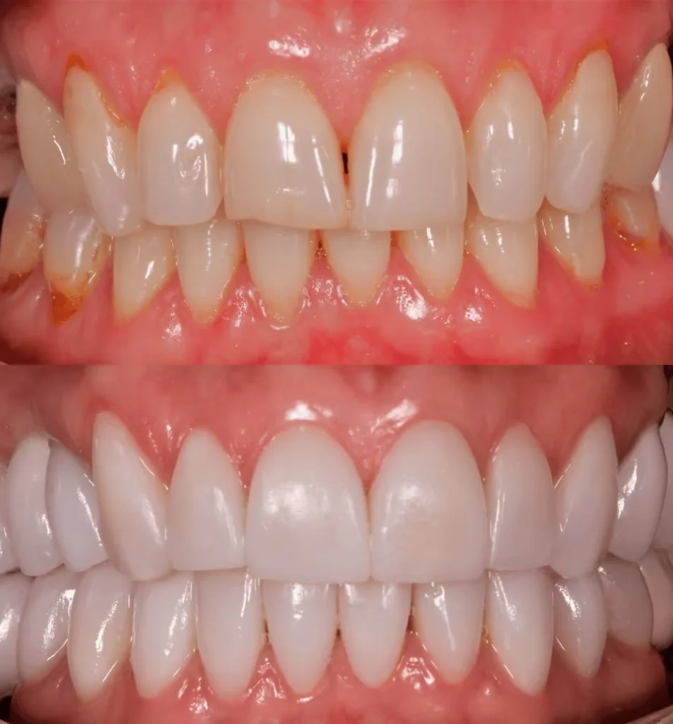 Porcelain Veneers and Dental Implants in Cali, Colombia