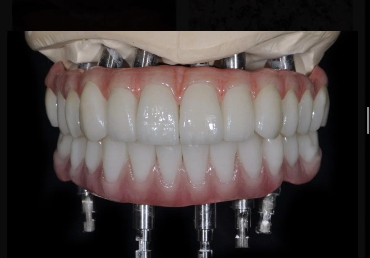 Upper and lower implant-supported restorations shown on dental models