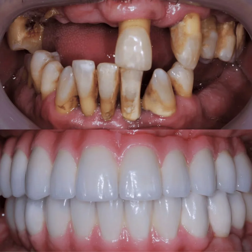 Dental Implants with Porcelain Crowns in Cali, Colombia