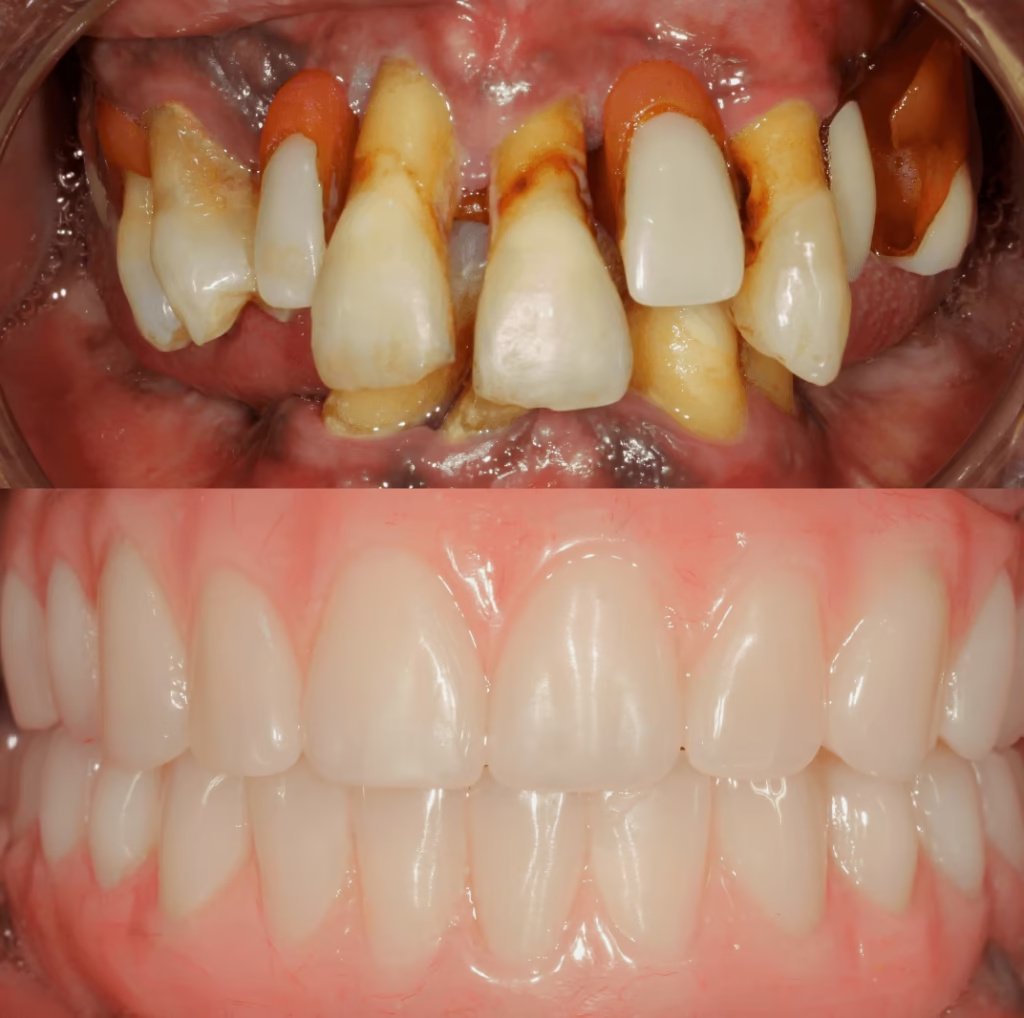 All-on-Four Dental Implants in Cali, Colombia