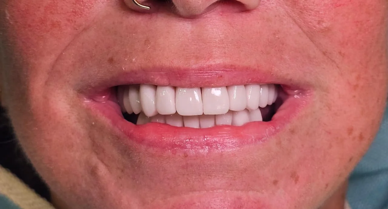 Natural smile after a treatment of dental Implants, crowns, and bridges in Cartagena