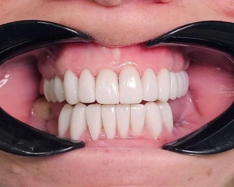 After a treatment of dental Implants, crowns, and bridges in Cartagena