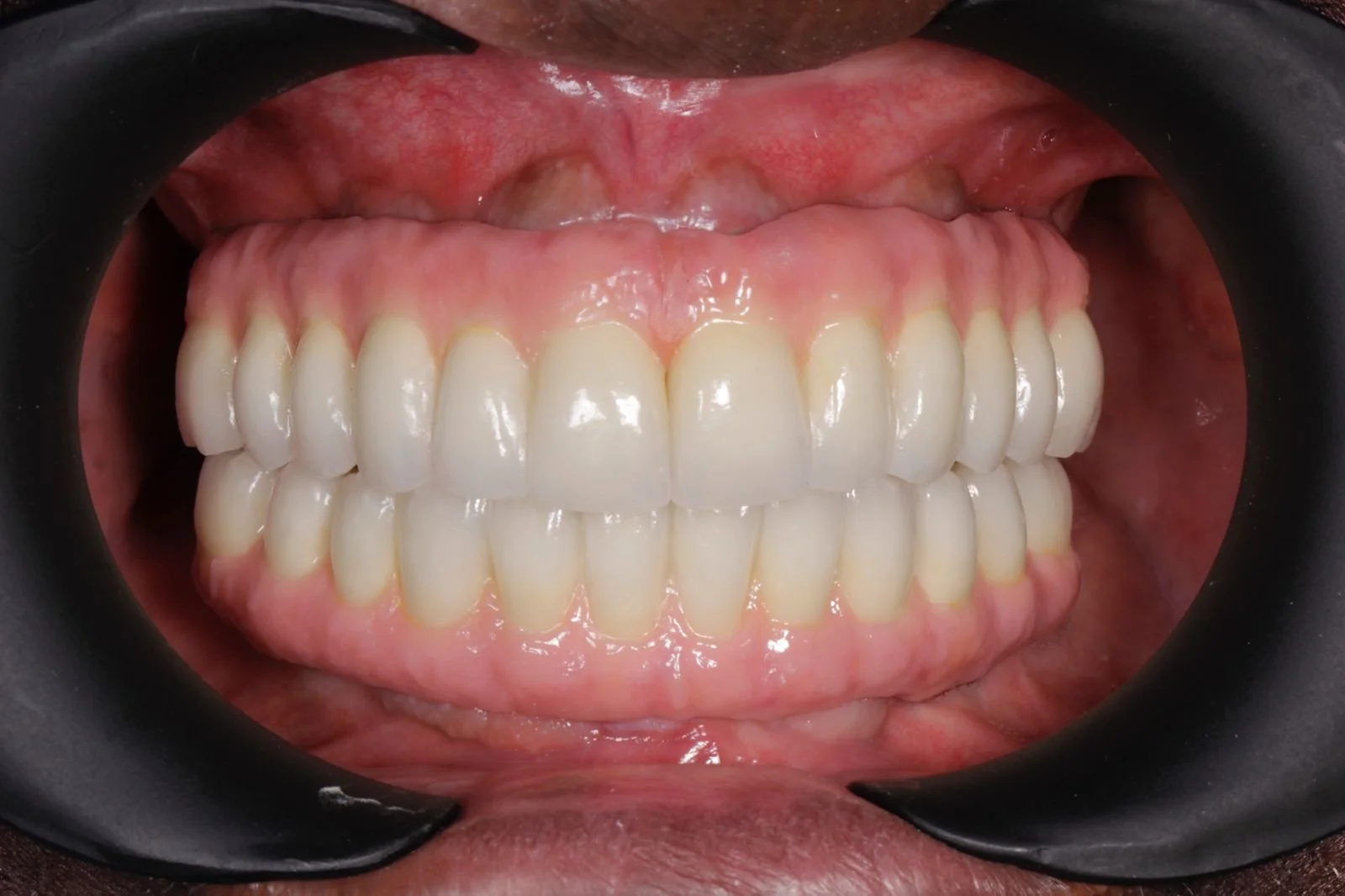 The Cost of Dental Implants in Colombia Dental Tourism Colombia