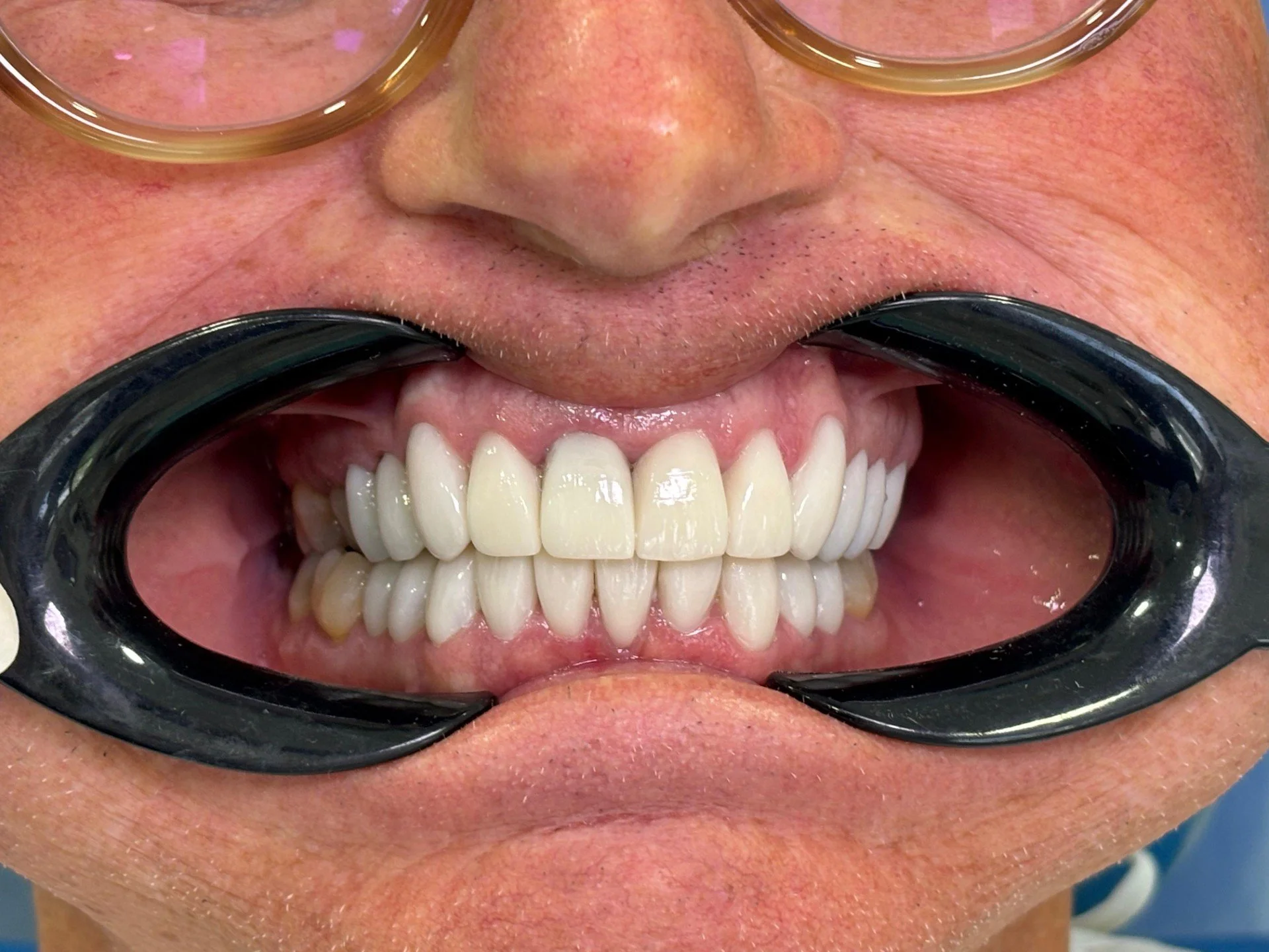 Dental implant smile in Cartagena, Colombia
