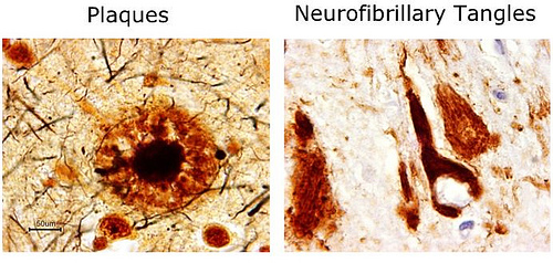 Neuropathology in Alzheimer's disease. Source: http://farm5.static.flickr.com/