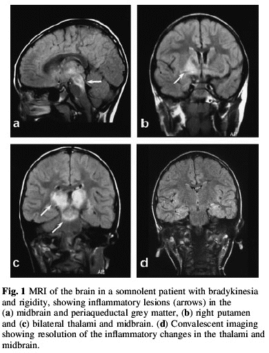 MRI of a patient with EL. Arrows point to areas of inflammation. Source: Ref 3