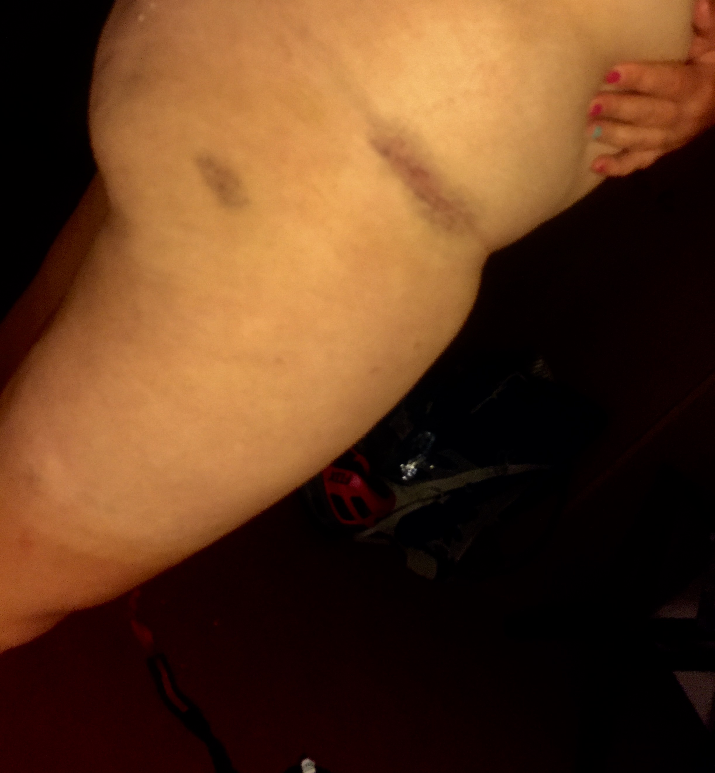 MTB stack bruises ow