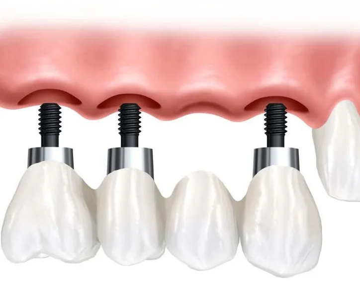 implant3.jpg