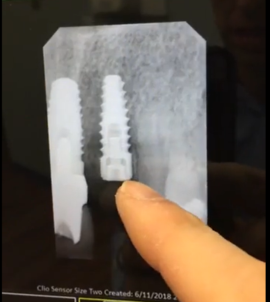 #ToothTalkTuesday: "Dental Implants 101"